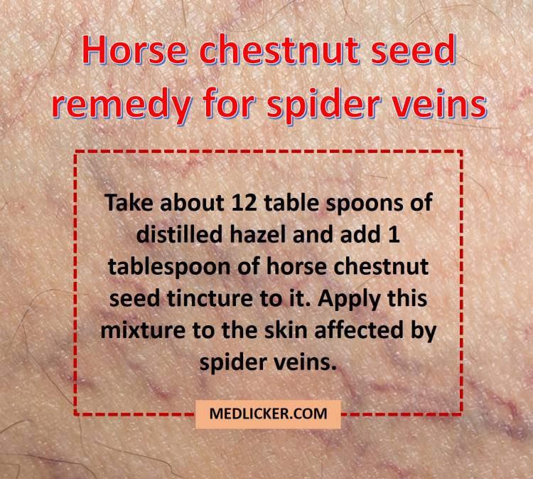 Horse chestnut seed remedy for spider veins