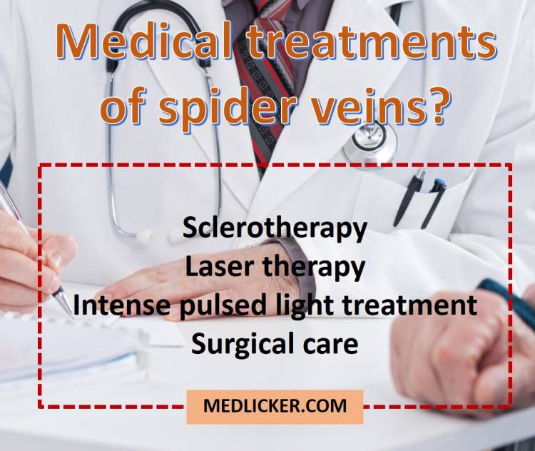 Overview of medical treatments for spider veins