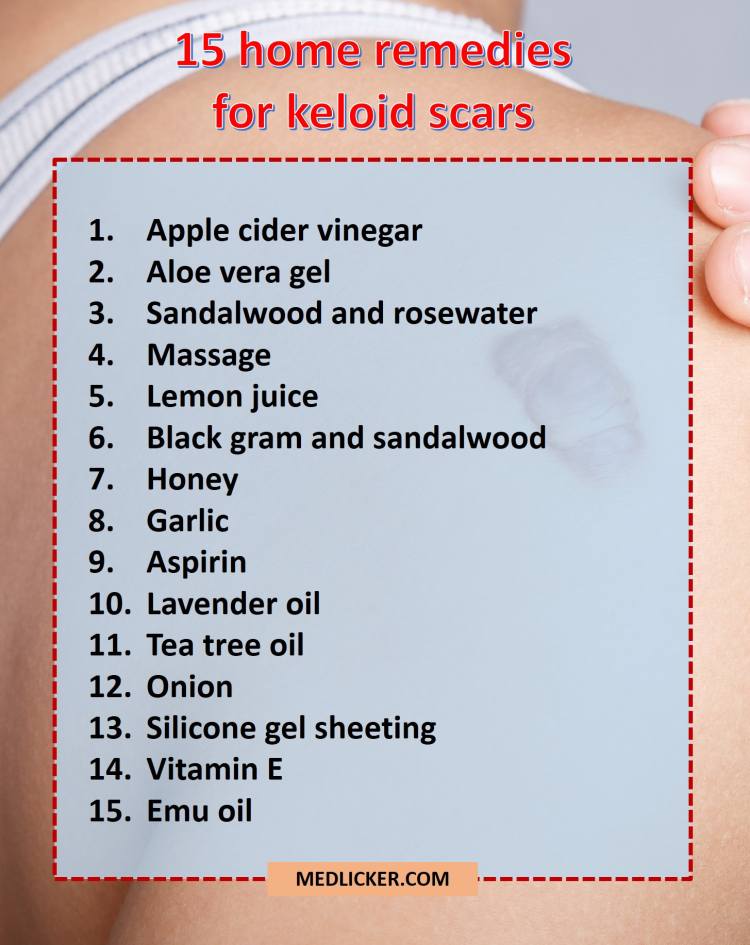 Fifteen natural home remedies for keloids
