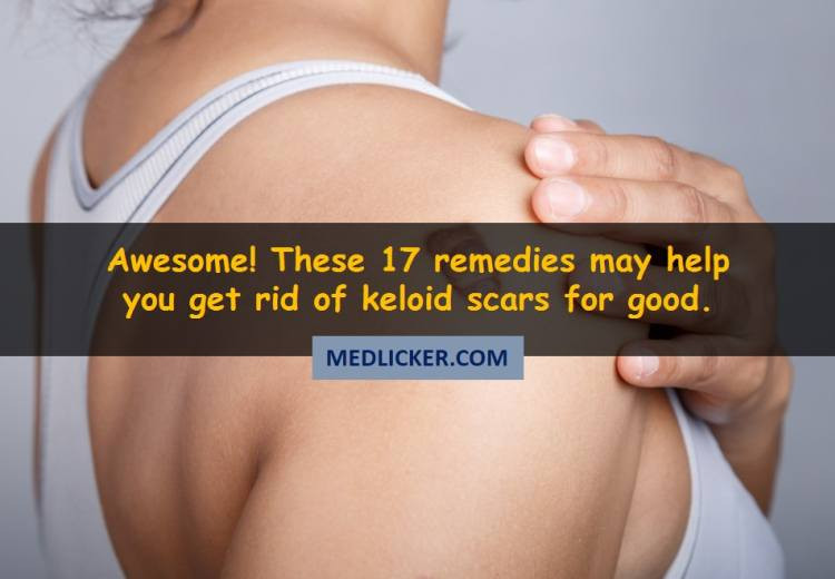 Awesome! These 17 medical and home remedies may help you get rid of keloid scars!