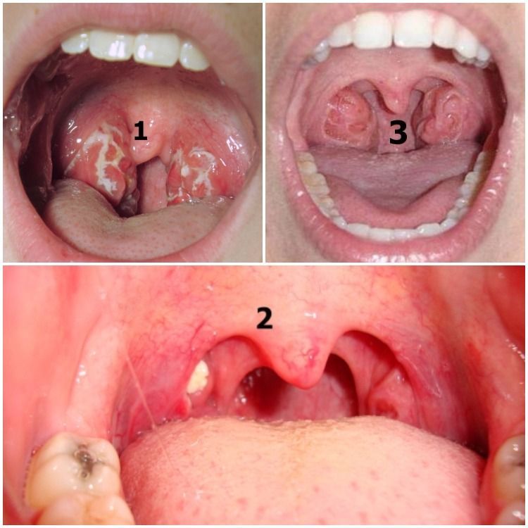 Here are three common presentations of holes in tonsils