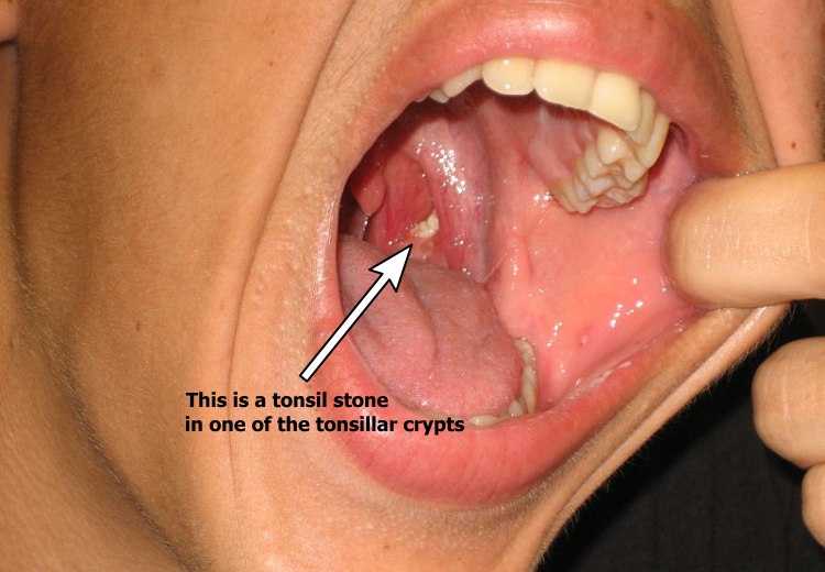 When holes in tonsils get larger, tonsil stones may fill them up