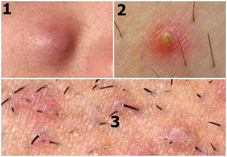 Ingrown Hair Armpit Lump Treatment