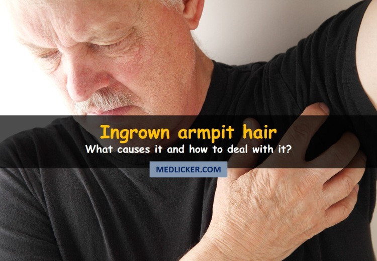 Ingrown Armpit Hair: Overview of Causes, Treatment and Prevention!