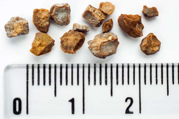 This is how kidney stones look like