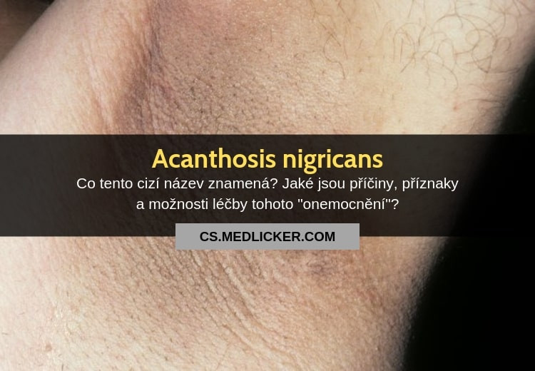 Co je acanthosis nigricans, jaké jsou její příčiny, příznaky a léčba?