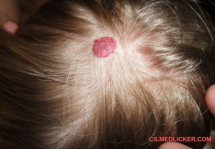 Hemangiom na kůži hlavy u dítěte