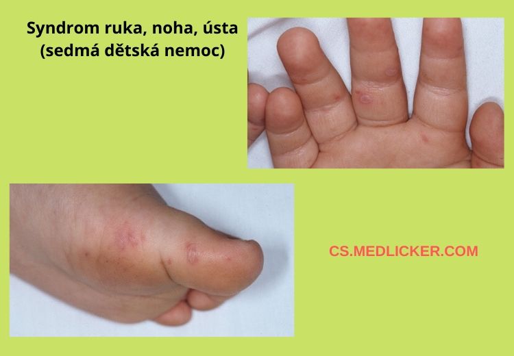 Syndrom ruka, noha, ústa - takhle vypadá vyrážka na rukou a nohou