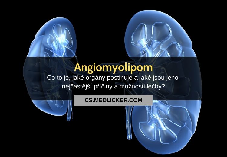 Co je angiomyolipom? Vše co potřebujete vědět!