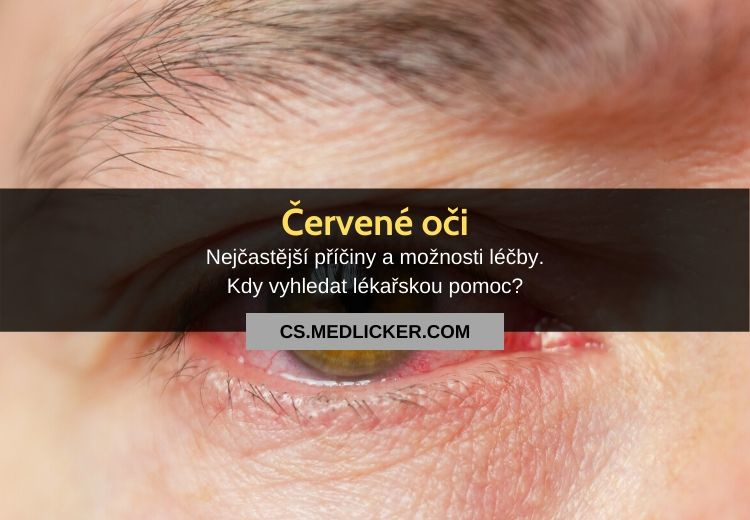 Co způsobuje červené oči? Časté příčin zarudlých očí a jejich léčba!