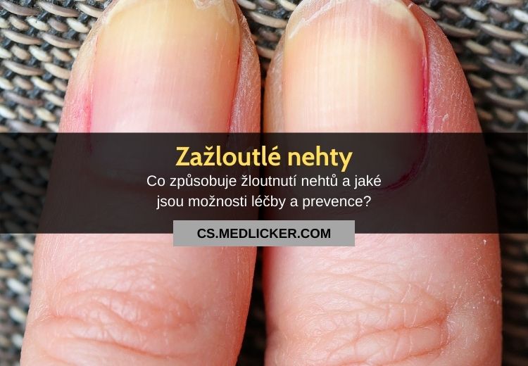 Nejčastější příčiny zažloutlých nehtů a jak se tohoto problému zbavit?