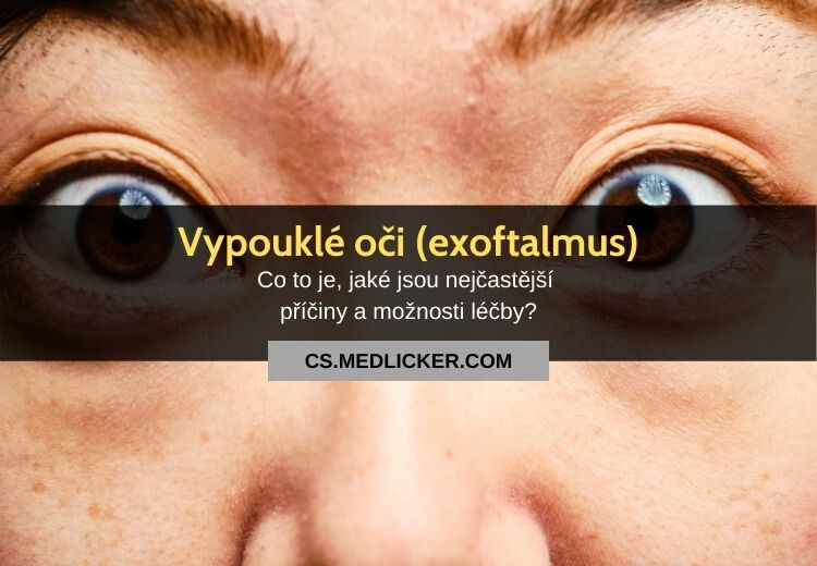 Vypouklé oči (exoftalmus, proptóza): vše co potřebujete vědět