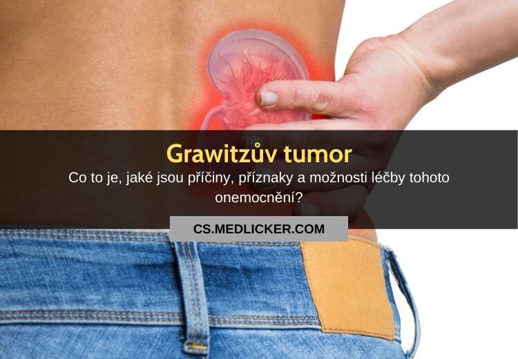Grawitzův tumor (renální karcinom): vše co potřebujete vědět!