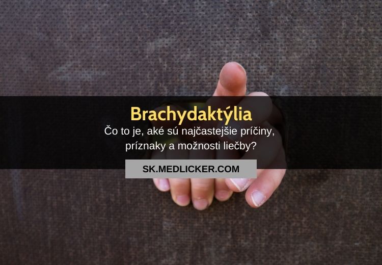 Abnormálne krátke prsty (brachydaktýlia): všetko čo potrebujete vedieť
