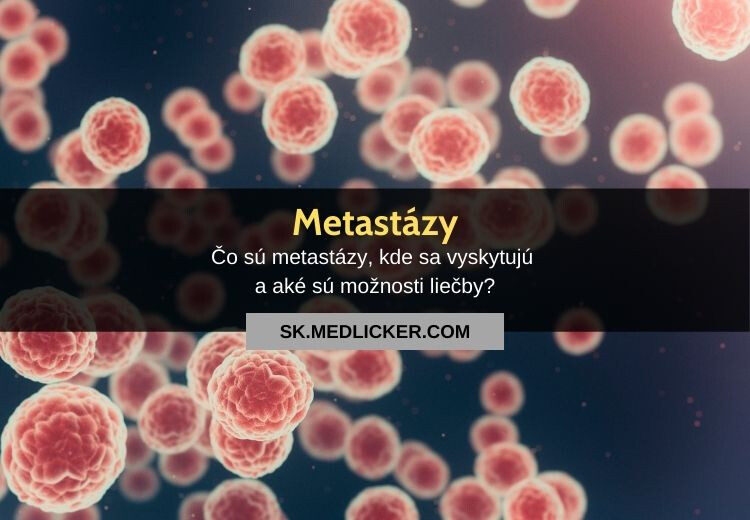 Čo sú metastázy?