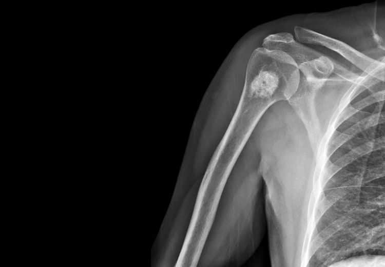 Na rentgenovém snímku vypadá enchondrom jako sklerotický okrsek v kosti
