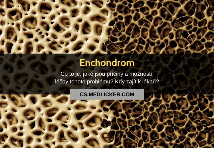 Co je enchondrom? Vše co potřebujete vědět!