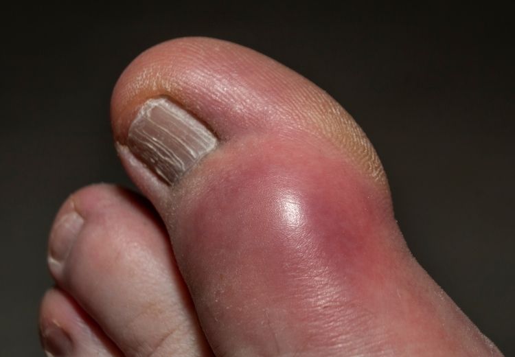 Dna je častou príčinou bolestí palca na nohe. Prejavuje sa opuchom, sčervenaním a bolesťou postihnutého palca.