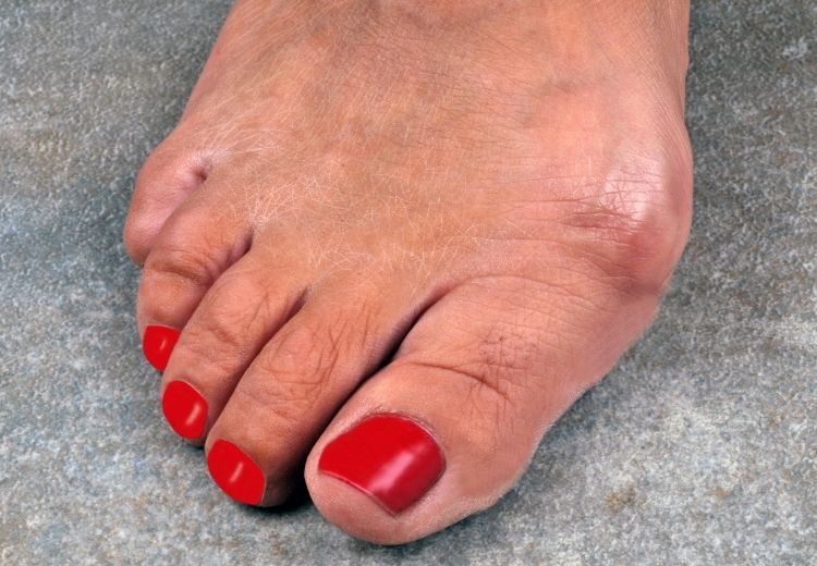 artróza palca na nohe