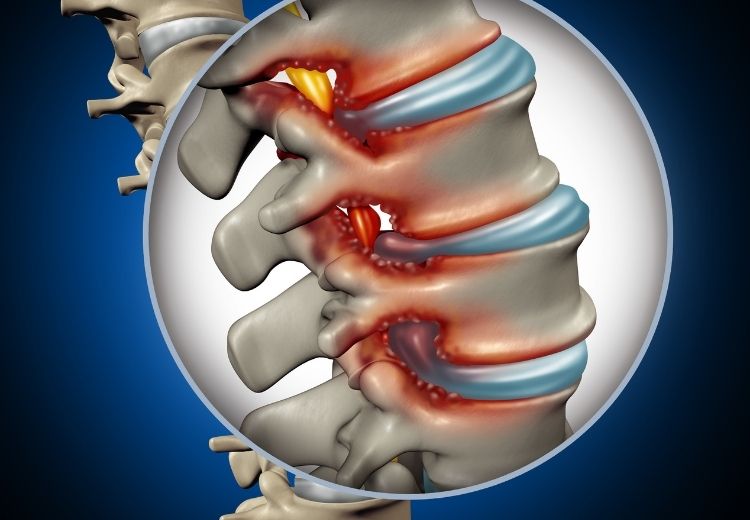 Fazetový syndróm je jednou z najčastejších príčin bolesti chrbta, najmä v oblasti bedrovej chrbtice.