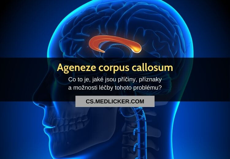 Ageneze corpus callosum: vše co potřebujete vědět!