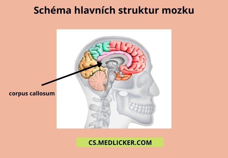 Při agenezi corpus callosum chybí v mozku důležitá anatomická struktura, která spojuje obě hemisféry
