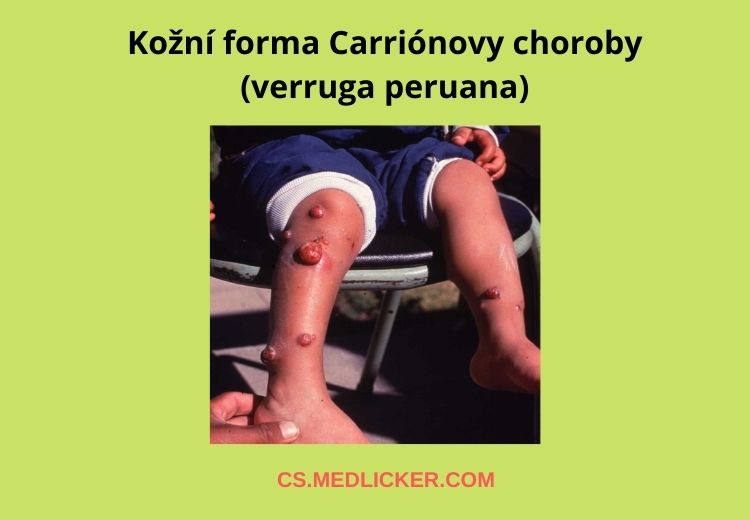 Kožní fáze Carriónovy choroby se nazývá také verruga peruana a projevuje se typickými lézemi na kůži