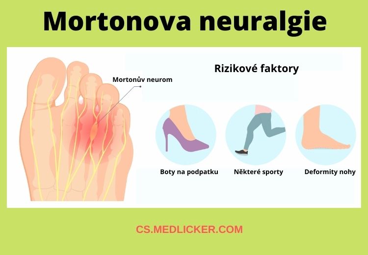 Rizikové faktory pro rozvoj Mortonovy neuralgie jsou nevhodná obuv, deformity přednoží a některé sportovní aktivity
