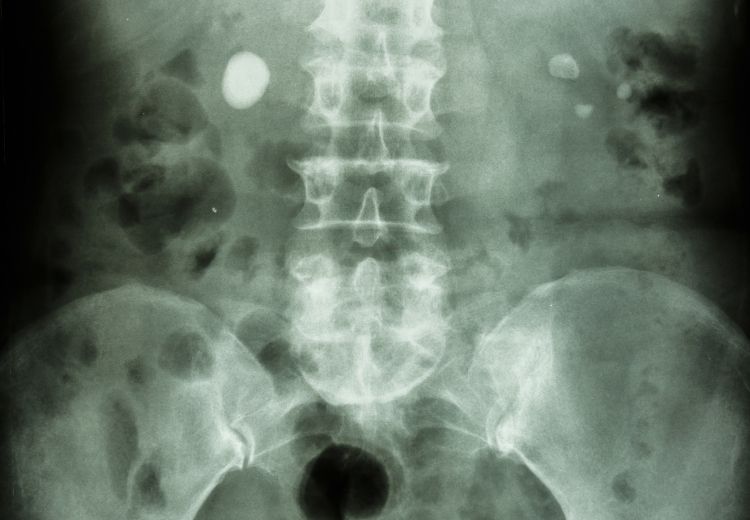 Pri diagnostike obličkovej koliky sa používajú zobrazovacie metódy ako röntgen, CT alebo ultrasonografické vyšetrenie