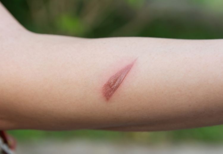 Popáleniny na kůži se obvykle špatně hojí. U horké páry je navíc problém, že jí můžeme vdechnout a popálit si dýchací cesty, což může být život ohrožující.