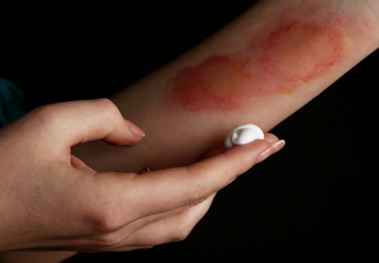 Popáleniny prvního stupně postihují jen pokožku (epidermis) a projevují se zčervenáním kůže, bez tvorby puchýřů