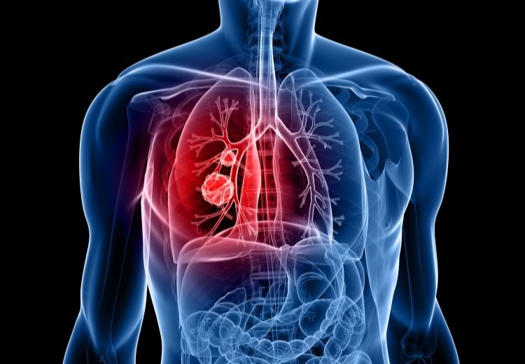 Rakovina pľúc je jednou z príčin tzv. malígneho pleurálneho výpotku