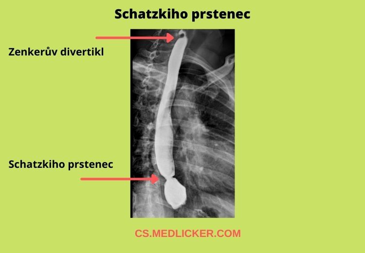 Schatzkiho prstenec je symptomatické zúžení gastroezofageální junkce, které se projevuje příznaky, jako jsou bolest při polykání nebo váznutí tuhé potravy v distálním jícnu