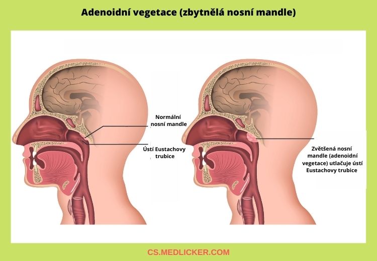 Zbytnělou nosní mandli (adenoidní vegetaci) je vhodné chirurgicky odstranit, protože komprimuje Eustachovu trubici a dutinu nosní a je spojena s opakovanými záněty středouší, chrápáním, huhňáním a dalšími obtížemi