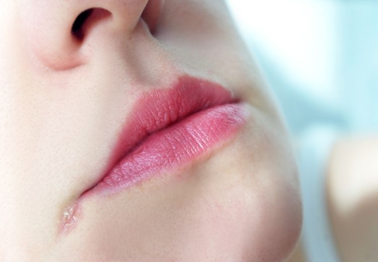 Bolavé koutky úst se projevují zarudnutím, popraskáním a bolestí ústního koutku