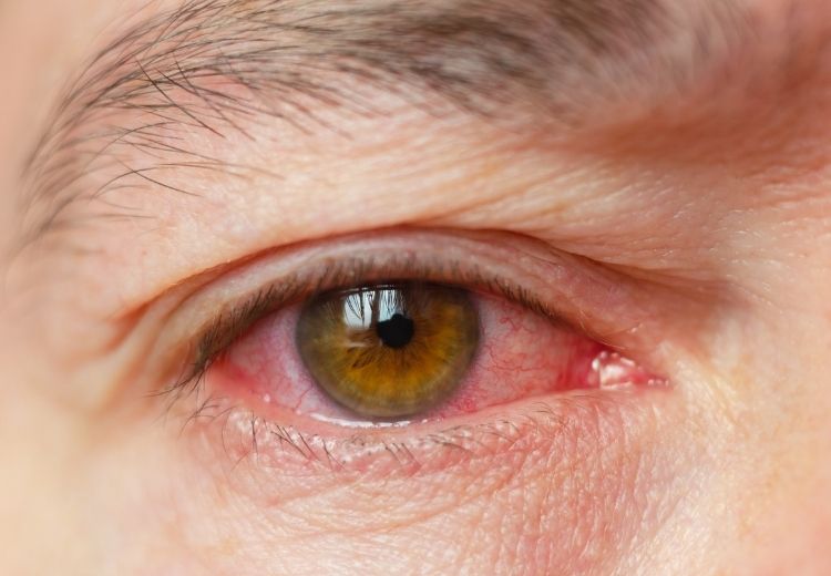 Jak zklidnit cervene oči?