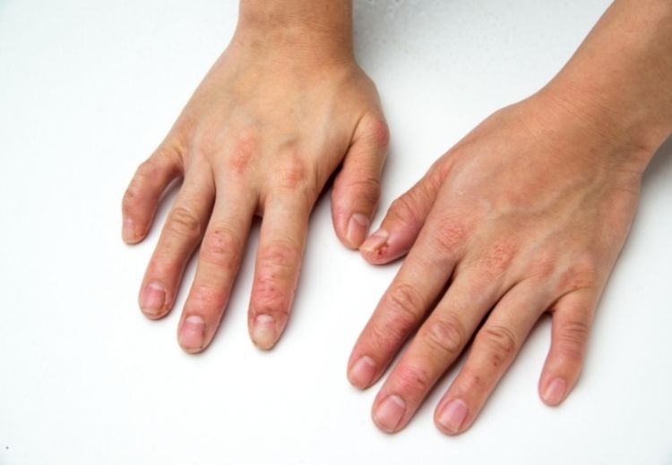 Jednou z příčin svědění dlaní a prstů je dyshidrotický ekzém nebo kontaktní dermatitida