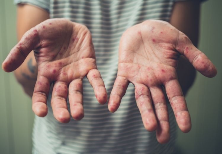 Častou příčinou svědění dlaní jsou kožní onemocnění a alergie jako jsou například dyshidrotický ekzém nebo kontaktní dermatitida.