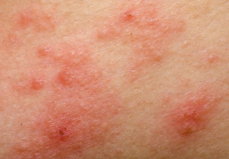Kontaktní dermatitida nebo alergie jsou častou příčinou svědění zad. Mezi projevy těchto onemocnění patří také různé exantémy.