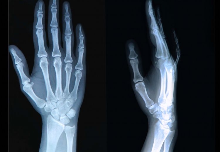 Rentgenový snímek umožňuje vyloučit či potvrdit luxaci kloubu palce a lze z něj odhalit i fraktury (zlomeniny) kostí. Nález na tomto snímku je normální.