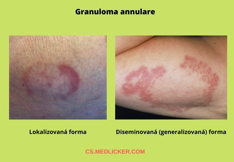 Existují tři různé formy granuloma annulare - lokalizovaná, diseminovaná neboli generalizovaná a podkožní
