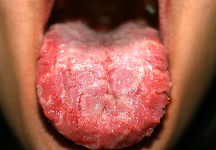 Hlavním příznakem moučnivky je bílý povlak na jazyku a dalších sliznicích dutiny ústní. Někdy může mít až charakter drobných nodulů či hrudek, které připomínají tvaroh.