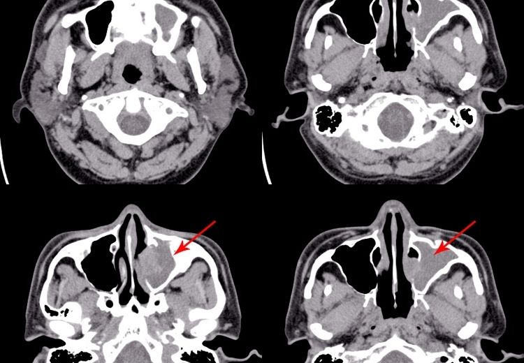 Diagnostika zánětu dutin je většinou klinická. V případě hrozících komplikací nebo u chronických zánětů se doporučuje CT vyšetření. Obrázek znázorňuje zánět maxillární dutiny vlevo.