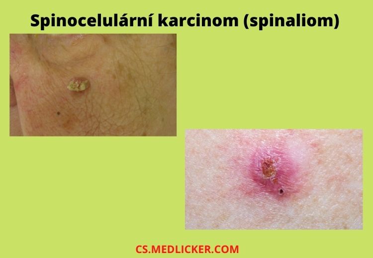 Spinocelulární karcinom (též squamocelulární karcinom neboli spinaliom) je druhým nejčastějším nemelanomovým kožním nádorem