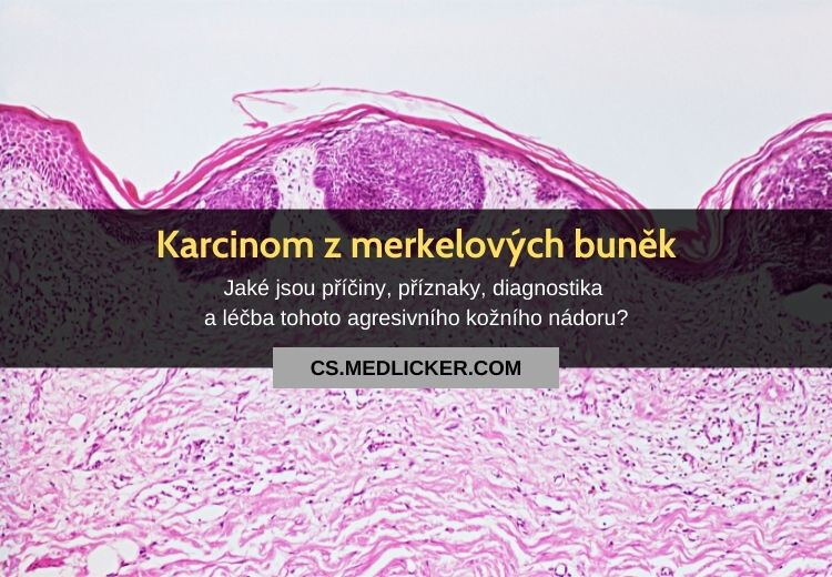 Kožní karcinom z Merkelových buněk: vše co potřebujete vědět