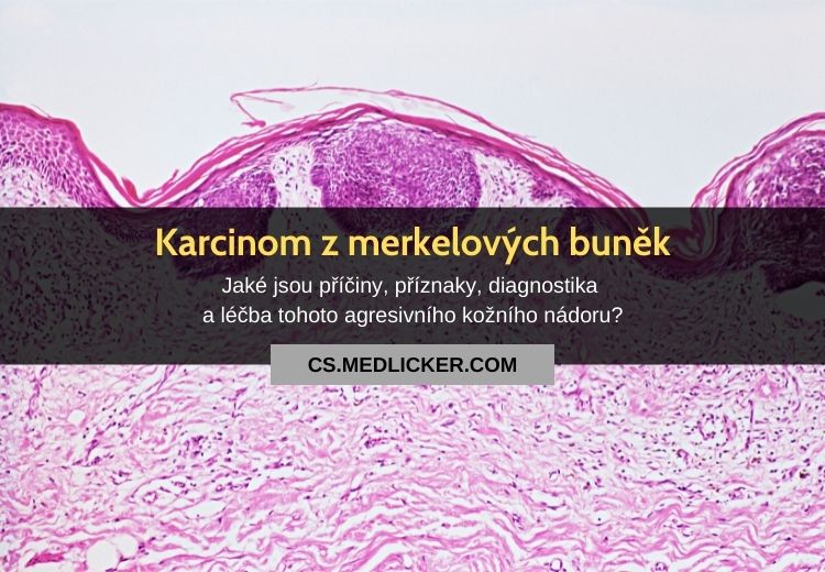 Kožní karcinom z Merkelových buněk: vše co potřebujete vědět