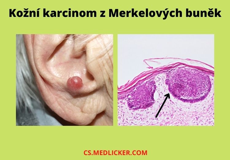 Kožní karcinom z Merkelových buněk vypadá jako bulka červené, tělové nebo jiné barvy, která rychle roste a šíří se do okolí