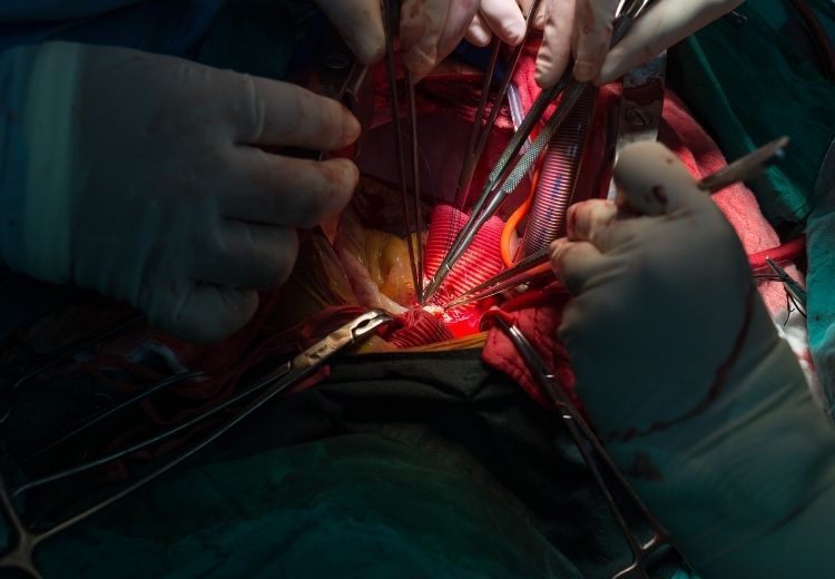 Disekce aorty typu A (Stanford A) se léčí operací, implantací stentgraftu a užíváním léků na snížení krevního tlaku a tepové frekvence