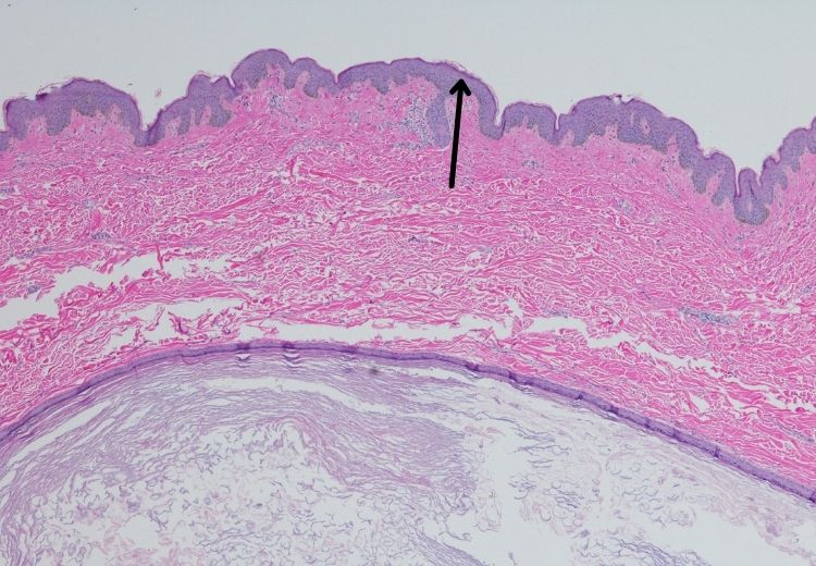 Epidermoidní cysta vzniká z buněk pokožky (epidermis), což je nejsvrchnější část kůže. Takhle to vypadá pod mikroskopem.