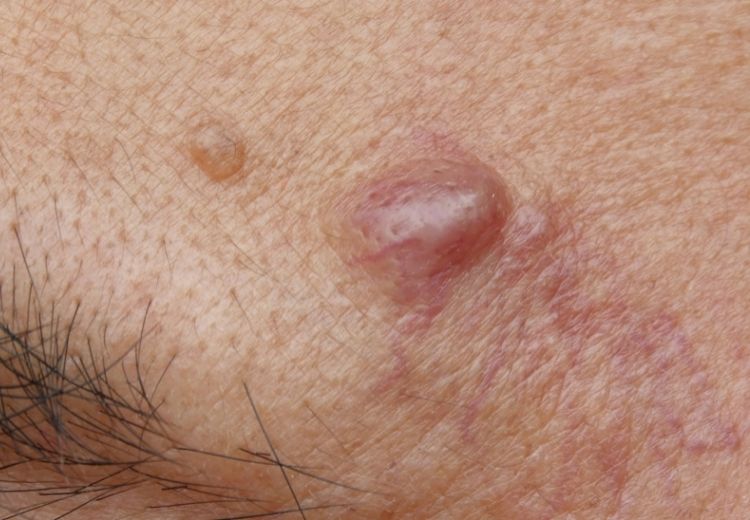 Epidermoidní cysta vypadá jako malá bulka na kůži. Její stěna je tvořena buňkami epidermis a je vyplněna keratinem. Zarudnutí kůže kolem může být projevem infekčních komplikací.